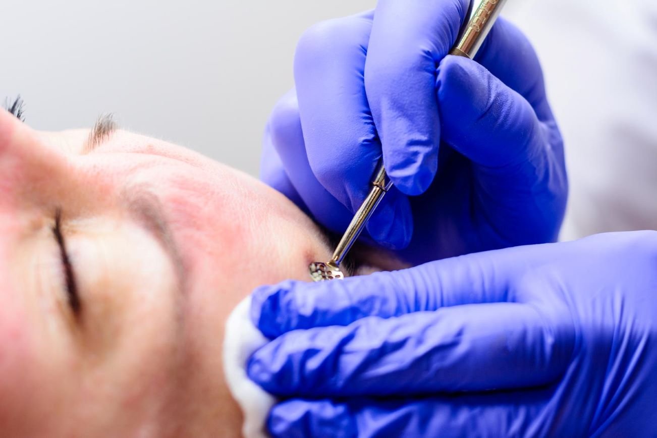 Redness Reduction Facial Treatment