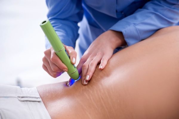 Scar Removal Laser Treatment for Stretch Marks