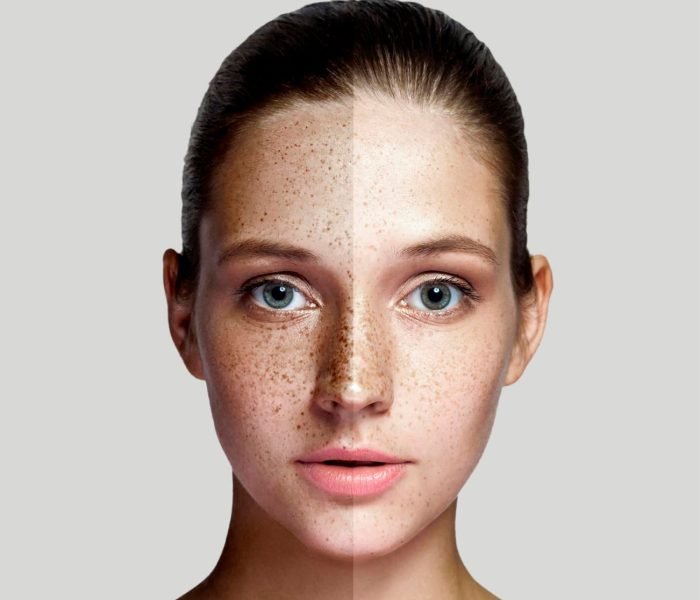 Close-up of a woman's face showing before and after results of Scar & Pigment Correction treatment.