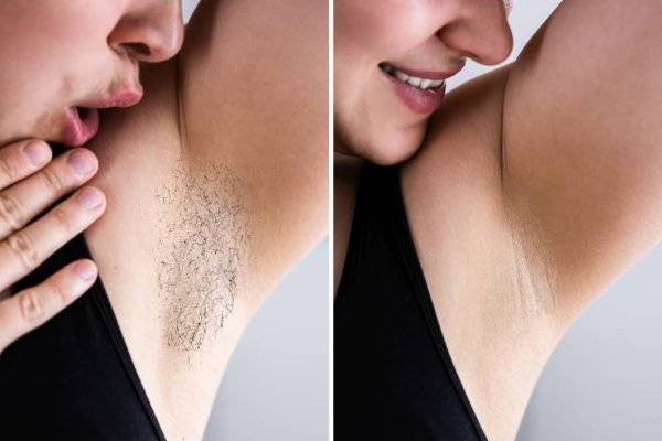 Before and after laser hair removal showing smooth, hair-free underarm. Image Description: