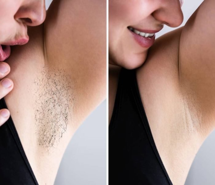 Before and after laser hair removal showing smooth, hair-free underarm. Image Description: